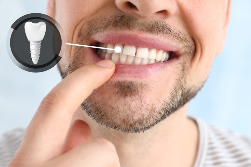Dream Dental | Dental Implants in Toms River, NJ: Are They the Right Choice for Replacing a Missing Tooth?
