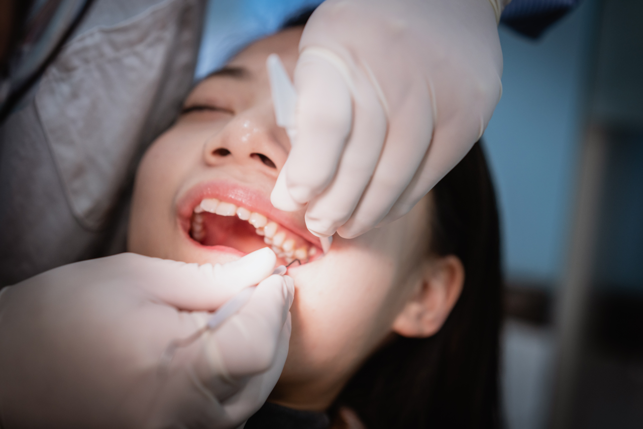 Dream Dental | Tooth-Colored Fillings in Toms River, NJ: How to Know When You Need One Dream Dental | Tooth-Colored Fillings in Toms River, NJ: How to Know When You Need One